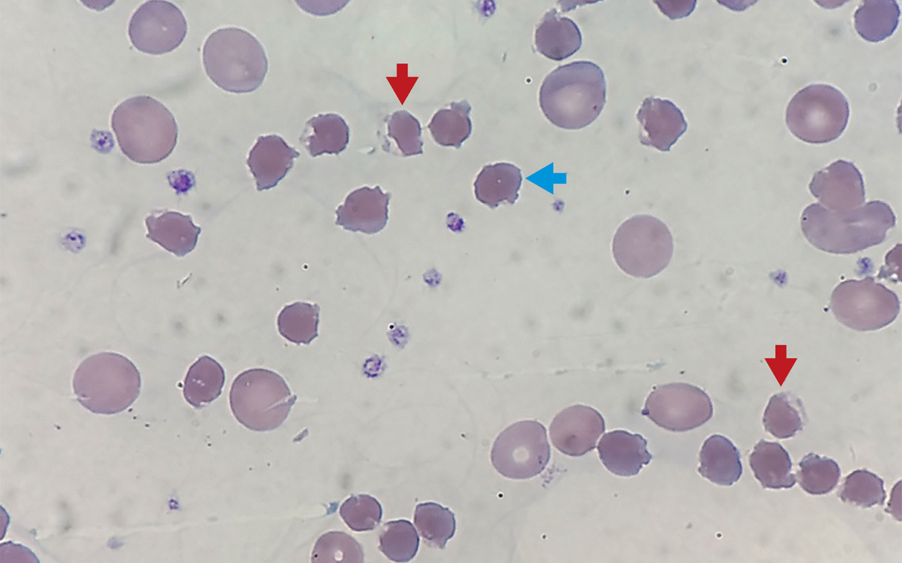 Massive oxidative haemolysis and renal failure caused by high dose