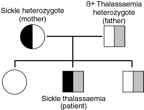 Sickle Cellβ Thalassaemia In A Papua New Guinean The First Reported 