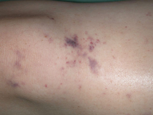 What Causes Purpura In Meningococcal Septicaemia