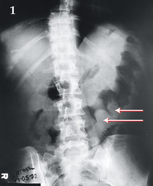 Bowel wall "thumbprinting" in pseudomembranous colitis | The Medical  Journal of Australia