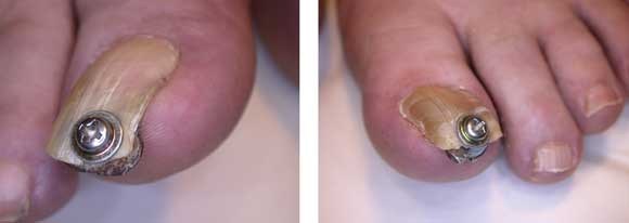 Anatomical Characteristics and Surgical Treatments of Pincer Nail Deformity