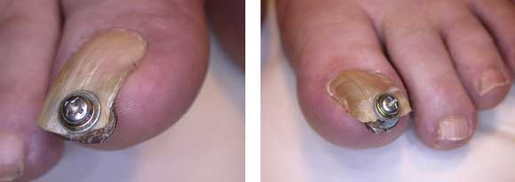 Gør livet basen nationalisme DIY pincer nail repair — brace yourself! | The Medical Journal of Australia