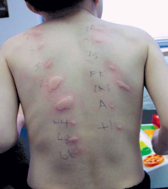 What Food Allergy Tests Mean - Kids With Food Allergies