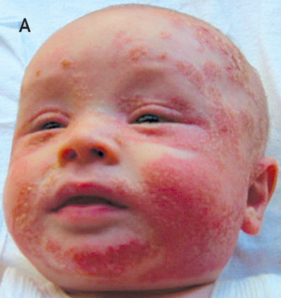 dermatitis in babies