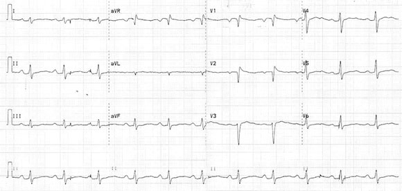 Prolonged Qt Interval Causes In Children