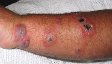 Purple Rash On Arms - Doctor answers on HealthTap