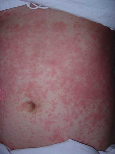 Vancomycin Rash