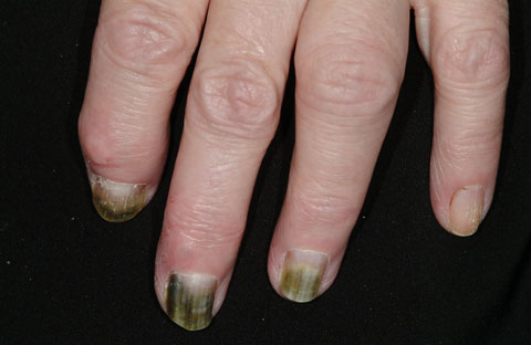 Pseudomonas chloronychia in a patient with nail psoriasis | The Medical  Journal of Australia