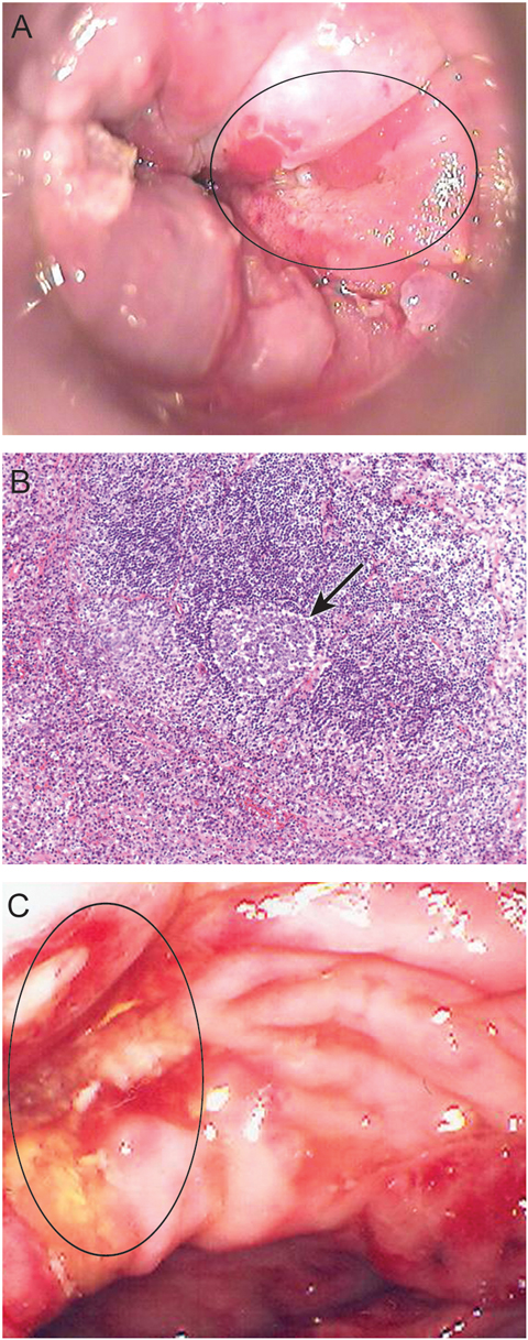 Corneal Ulcer Picture Image on MedicineNet.com