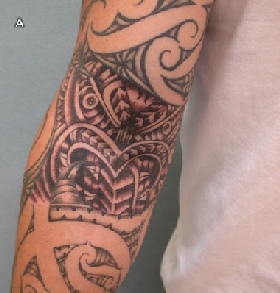 Mycobacterium chelonae infection in a tattoo site | The Medical Journal of  Australia