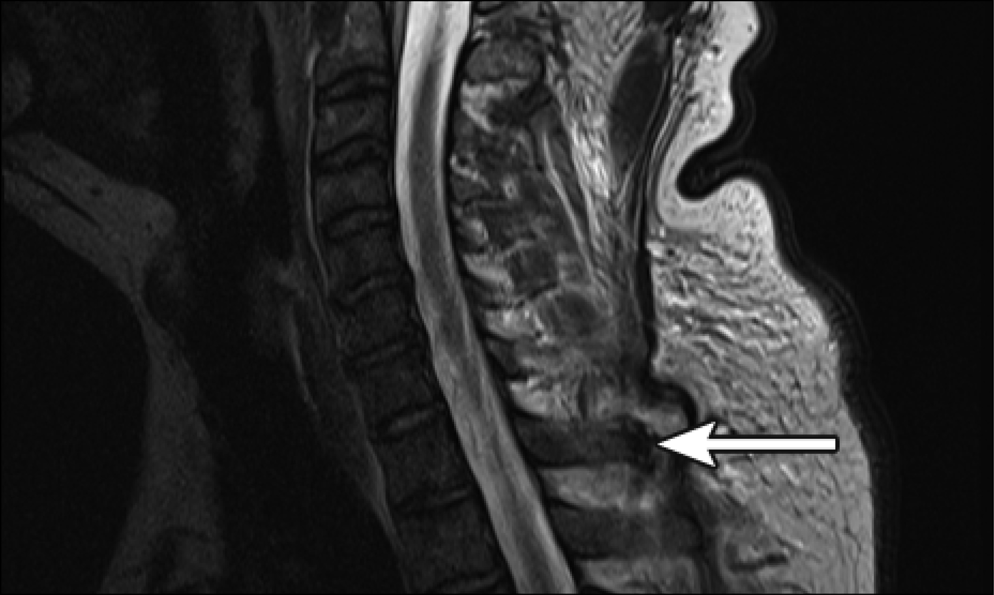 Spinal gout mimicking osteomyelitis The Medical Journal of Australia