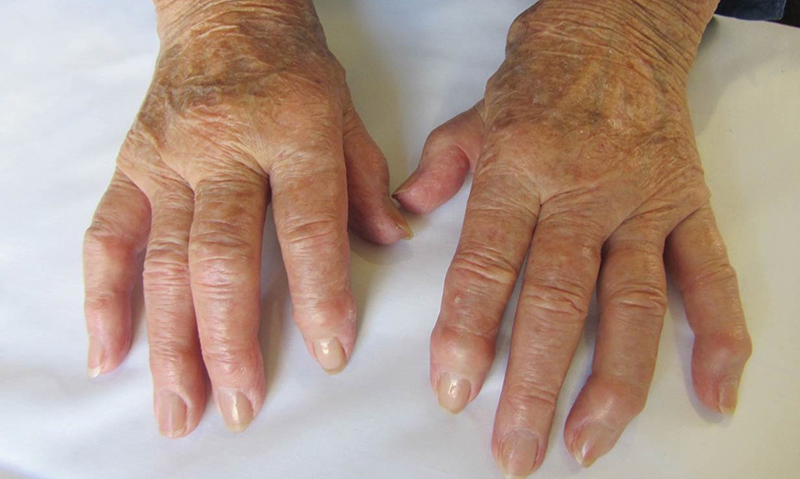 Advances In Rheumatoid Arthritis The Medical Journal Of Australia