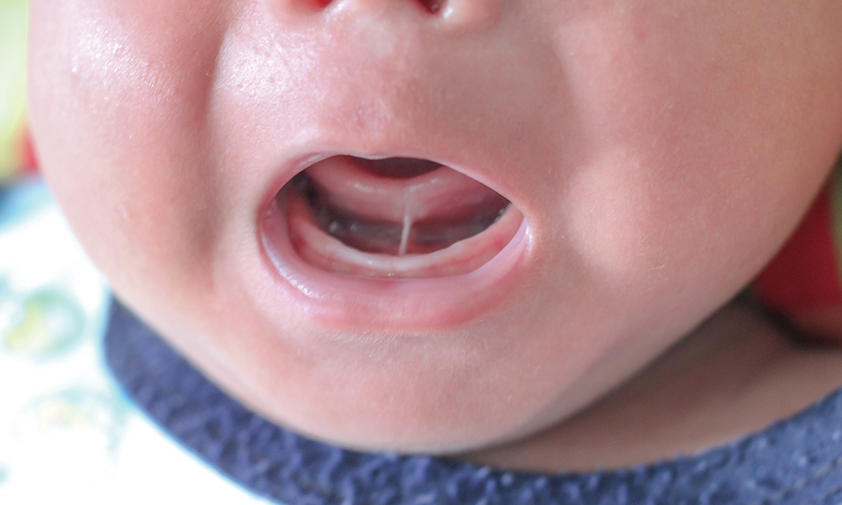 Tongue-tie and frenotomy: what evidence do we have and what do we need