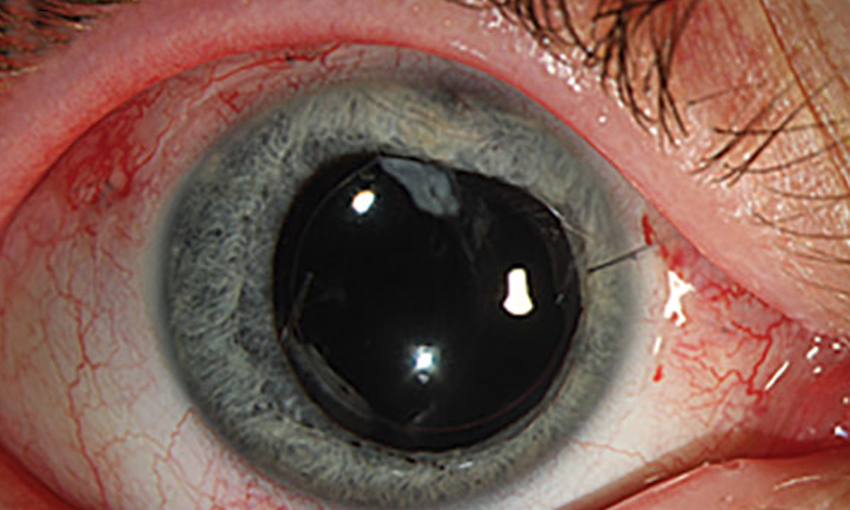 Traumatic eye injury from an exploding aerosol can | The Medical