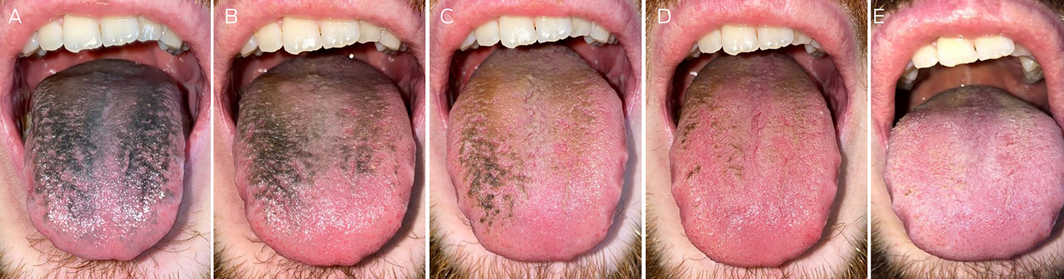 Black Hairy Tongue Its Gross but Youll Live  HowStuffWorks
