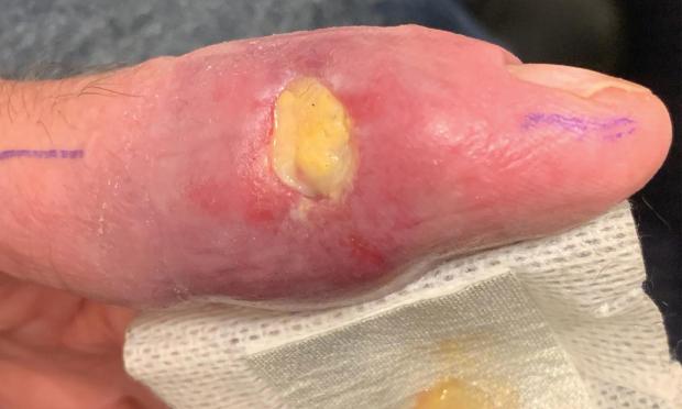 Possum bites man: case of Buruli ulcer following possum bite