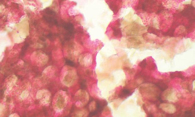 Iron deficiency and new insights into therapy