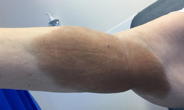 Iron stain following an intravenous iron infusion