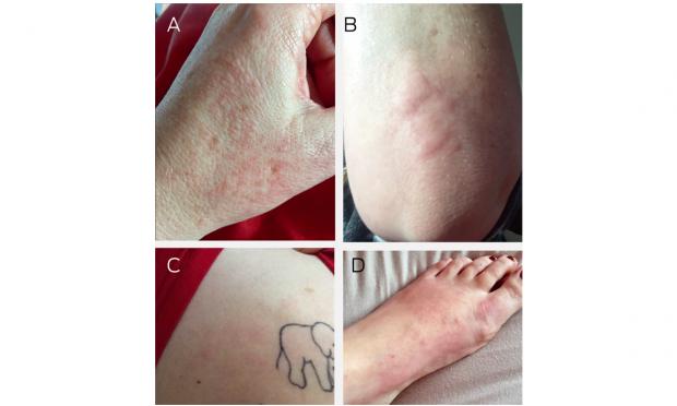 Cutaneous manifestations of COVID‐19: diagnosis and management